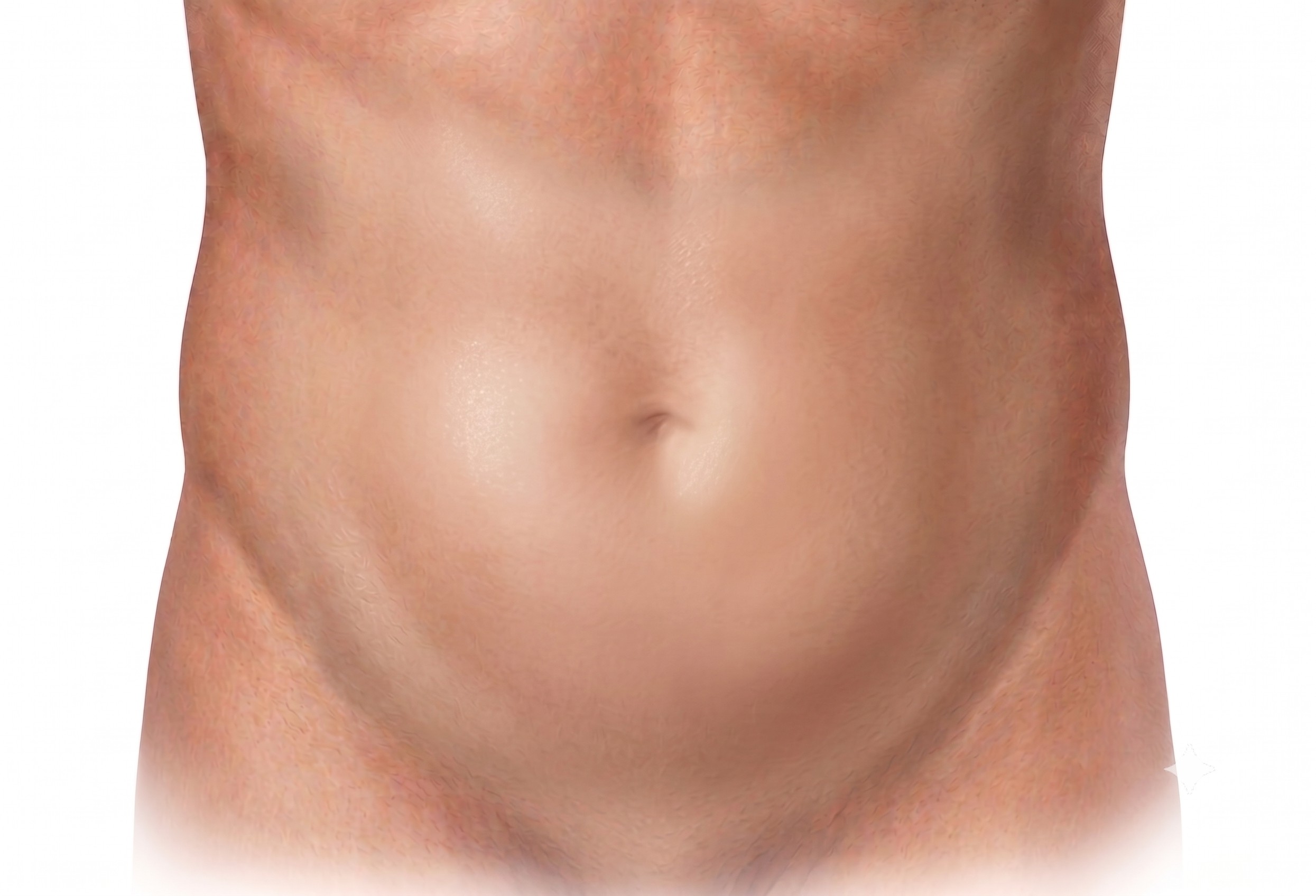 単孔式腹腔鏡下虫垂切除術の切開位置の模式図。へその上をまっすぐに約2cmの切開を1か所だけ置く。